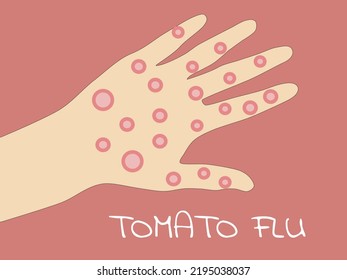 Red pimples or blisters on palm , hand and body this is one of symptoms of tomato flu