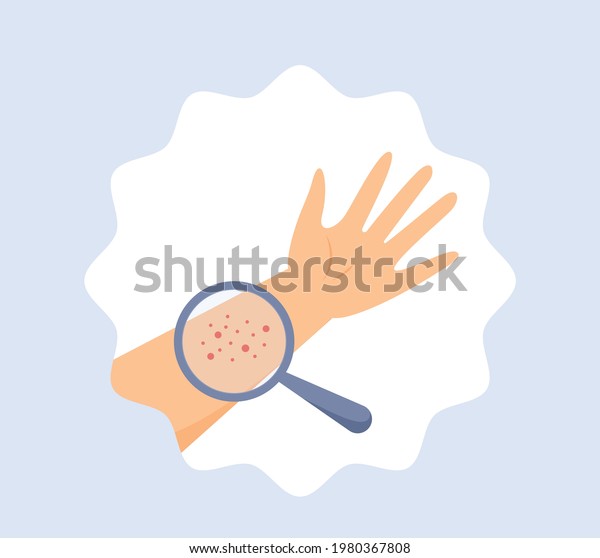 Une éruption rouge sur la main. : image vectorielle de stock (libre de ...