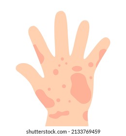 Red rash on hand in flat design on white background. Itching and irritation symptom. Skin allergy.
