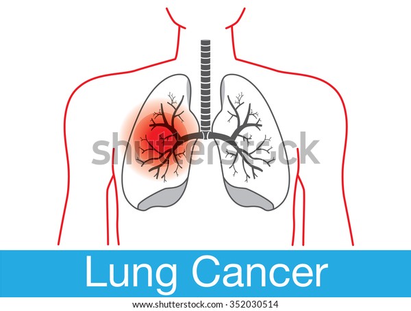 Red Sign On Human Lungs Area Stock Vector (Royalty Free