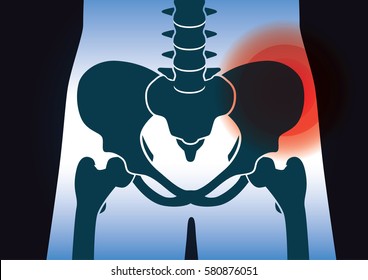 Red signal at the bone of the pelvic girdle. Illustration about medical and health.