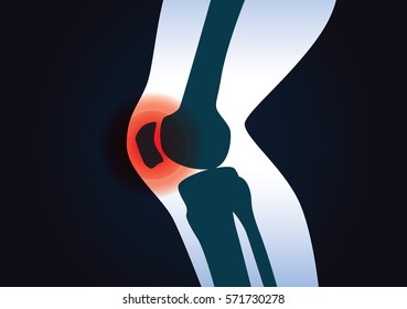 Red signal at knee area. This illustration about human leg injury.