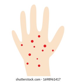 Manchas rojas en la mano infantil de piel clara. Concepto de enfermedades de la piel, ilustración de la población vectorial