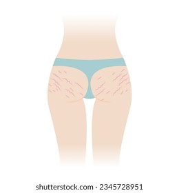 Red stretch marks on buttocks vector illustration isolated on white background. The striae rubrae appear on the bottom, hip, ass back of woman body. Skin care and beauty concept.