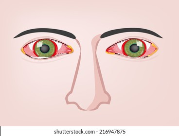 Reddish eye due to viral, bacterial or allergic conjunctivitis vector