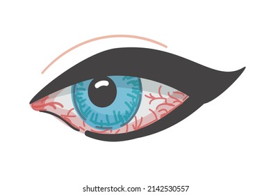 Rötung des Auges. Augenkrankheit. Vektorgrafik. Isolierte Ikone. Cartoon-Stil. Konjunktivitis.