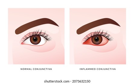 Redness Eye symptom. Uveitis symptoms or Eye Inflammation.