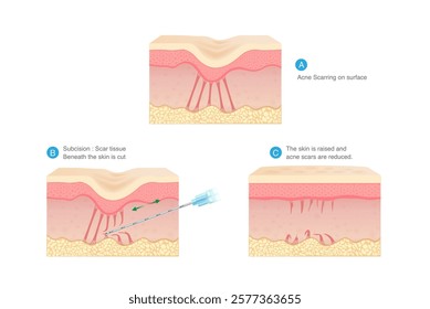 Reduce acne scar with micro surgical technique that called Subcision. 3 steps of cutting fibrous bands under skin layers tethered down for treatment acne scar.