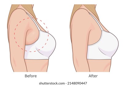 Reduce bra bulge. Woman armpit fat loss vector illustration. Before and after.