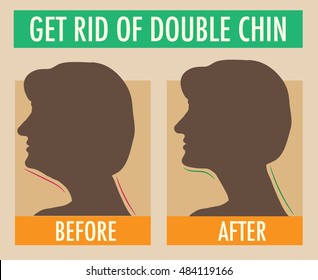 Reduce double chin. Get rid of face and neck fat concept. Vector illustration for beauty or plastic surgery infographic, before and after. Silhouettes of female head, side view. Fat and slim jaw line.