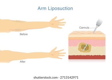 Reduzca el exceso de grasa del brazo con liposucción. Las mujeres hacen que el brazo caído se vea más firme y más hermoso. Capa de la piel que muestra la cánula elimina el exceso de grasa de las capas internas de la piel.