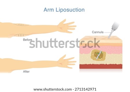 Reduce excess arm fat with Liposuction. Woman make sagging arm look firmer and more beautiful. Skin layer showing Cannula removes excess fat from the inner layers of the skin.