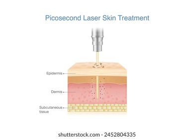 Reduce freckles, blemishes, wrinkles and spots by Picosecond Laser breaks down pigmentation in skin layer into smaller fragments. Medical laser called Pico.