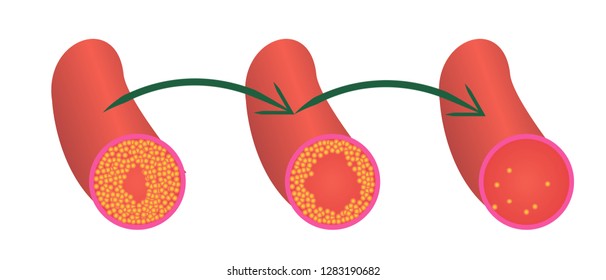 Reduce Levels Of Cholesterol Plaque In Vessels Vector Illustration