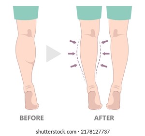 Reduce Slim Leg Size Lose Fat Gel Deformity Lift Resection Gastrocnemius Neurectomy Reshapes Ankle Beauty Body Care Female Fitness Treat Women Grafting Transfer Filler Pain Male Toxin Calf Limb Polio