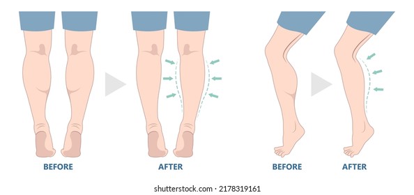 reduce slim leg size lose fat Gel deformity lift resection gastrocnemius neurectomy reshapes ankle beauty body care female fitness treat women grafting transfer Filler pain male toxin calf limb polio