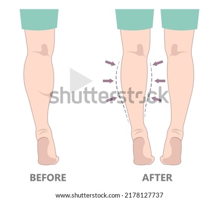 reduce slim leg size lose fat Gel deformity lift resection gastrocnemius neurectomy reshapes ankle beauty body care female fitness treat women grafting transfer Filler pain male toxin calf limb polio