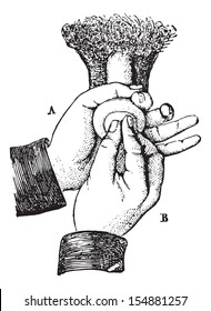 Reduction of paraphimosis the ordinary method, vintage engraved illustration. Usual Medicine Dictionary - Paul Labarthe - 1885.