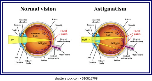 Refractive Errors Eyeball. Astigmatism.