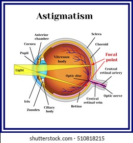 Refractive errors eyeball. Astigmatism.