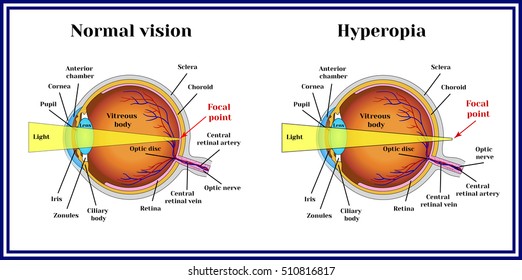 A látás megduplázza a tárgyakat Hyperopia és diplopia