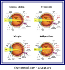 refractive error (myopia hyperopia astigmatism) rövidlátás szülés után