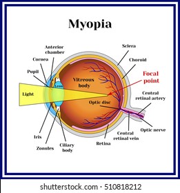 Refractive errors eyeball. Myopia.