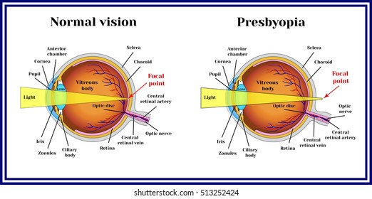 Refractive Errors Eyeball Hyperopia Myopia Astigmatism Stock Vector ...