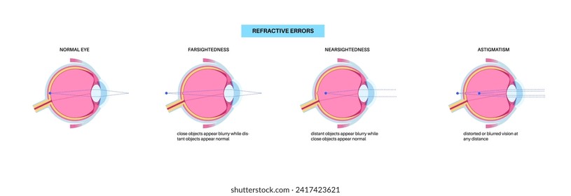 Refractive errors poster. Normal eye, astigmatism, myopia and hyperopia diseases. Nearsightedness and farsightedness concept. Short sightedness, long sightedness vision disorder vector illustration