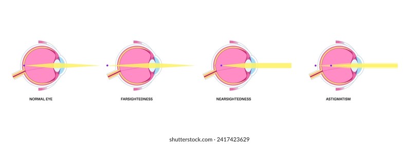 Refractive errors poster. Normal eye, astigmatism, myopia and hyperopia diseases. Nearsightedness and farsightedness concept. Short sightedness, long sightedness vision disorder vector illustration