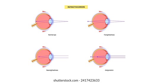 Refractive errors poster. Normal eye, astigmatism, myopia and hyperopia diseases. Nearsightedness and farsightedness concept. Short sightedness, long sightedness vision disorder vector illustration