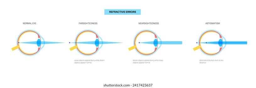 Afiche de errores refractivos. Enfermedades oculares normales, astigmatismo, miopía e hiperopía. Concepto de visión de futuro y visión de futuro. Visión corta, visión a largo plazo desorden de visión ilustración vectorial