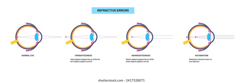 Refraktive Fehler Poster. Normale Augen, Astigmatismus, Myopie und Hyperopie. Konzept der Kurzsichtigkeit und Weitsichtigkeit. Kurzsichtigkeit, Sehstörungen der Sehkraft, Vektorgrafik