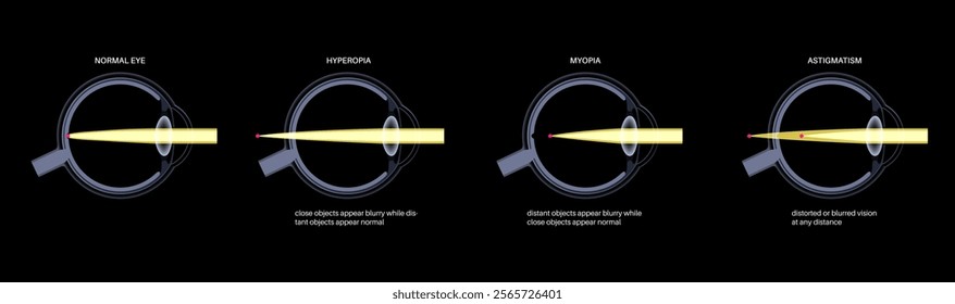 Refractive errors poster. Normal eye, astigmatism, myopia and hyperopia diseases. Nearsightedness and farsightedness concept. Short sightedness, long sightedness vision disorder vector illustration