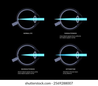 Refractive errors poster. Normal eye, astigmatism, myopia and hyperopia diseases. Nearsightedness and farsightedness concept. Short sightedness, long sightedness vision disorder vector illustration