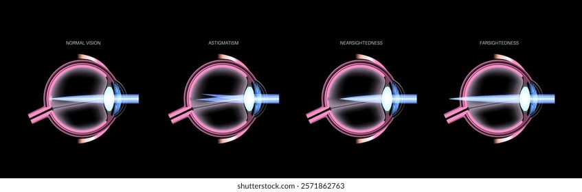 Refractive errors poster. Normal eye, astigmatism, myopia and hyperopia diseases. Nearsightedness and farsightedness concept. Short sightedness, long sightedness vision disorder vector illustration