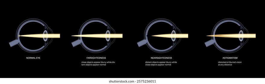 Refractive errors poster. Normal eye, astigmatism, myopia and hyperopia diseases. Nearsightedness and farsightedness concept. Short sightedness, long sightedness vision disorder vector illustration