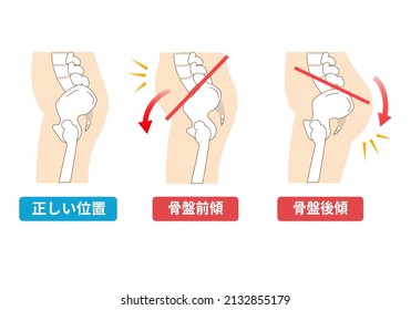 Relationship Between Pelvic Tilt And Posture
