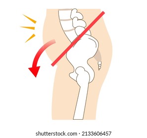 Relationship Between Pelvic Tilt And Posture
