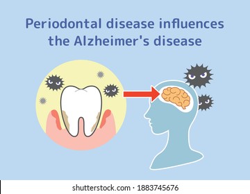 Relationship between periodontal disease and Alzheimer's disease