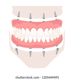 Removable denture on implants. Removable denture of the upper and lower jaw on four implants. Implant of the upper and lower jaw. Full arch prosthesis on dental implants. Vector illustration