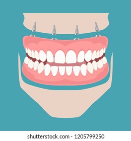 Removable Denture On Implants. Removable Denture Of The Upper And Lower Jaw On Four Implants. Implant Of The Upper And Lower Jaw. Full Arch Prosthesis On Dental Implants. Vector Illustration