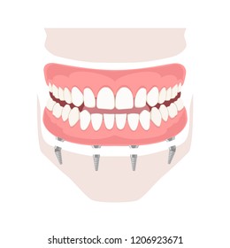 Removable Denture On Implants. Removable Denture Of The Upper And Lower Jaw On Four Implants. Implant Of The Upper And Lower Jaw. Full Arch Prosthesis On Dental Implants. Vector Illustration