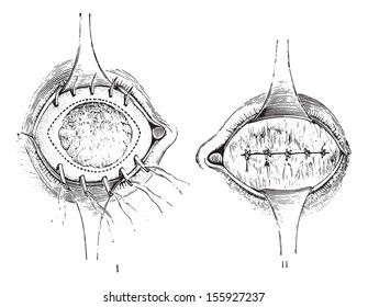 Removal of the anterior segment of the eye with total staphyloma, Suture, after removal of the anterior staphyloma, vintage engraved illustration. Usual Medicine Dictionary by Dr Labarthe - 1885.