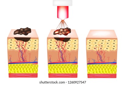 Removal of birthmarks, popiloma, wart laser. The structure of moles on the skin. Infographics. Vector illustration on isolated background.