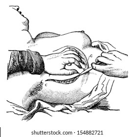 Removal of the breast (the first time), vintage engraved illustration. Usual Medicine Dictionary - Paul Labarthe - 1885.