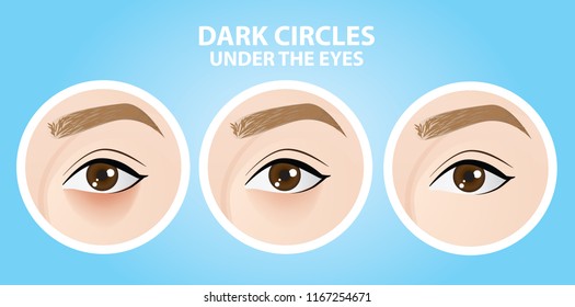 Removal Of Dark Circles Under The Eyes Vector Illustration 