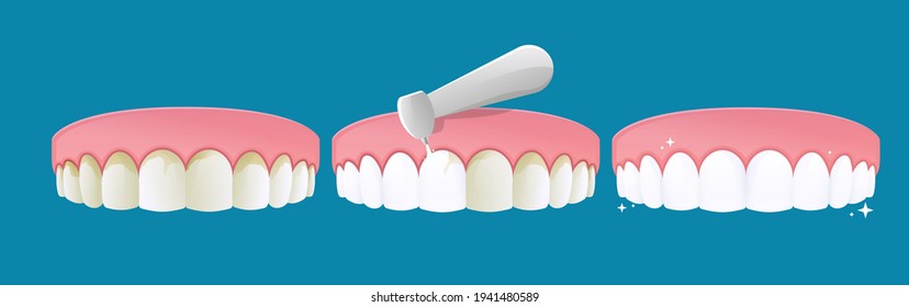 Removal of dental stones. Cleaning dental plaque. Vector cartoon style.