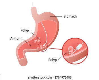 Removal of gastric polyps, masses of cells inside stomach. pedunculated and flat-based polyp. Antrum. Medical vector illustration marked with lines.