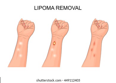 Removal of lipoma on forearm illustration svg